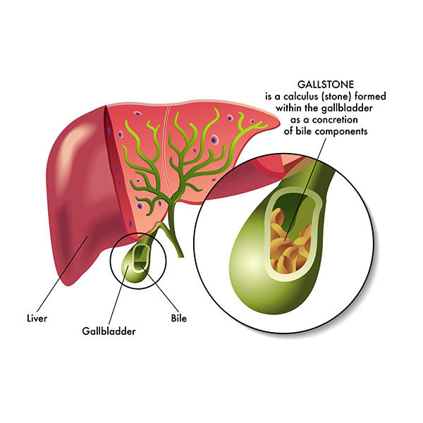 Gallbladder Stones Guide - Symptoms, Treatment and Home Remedies