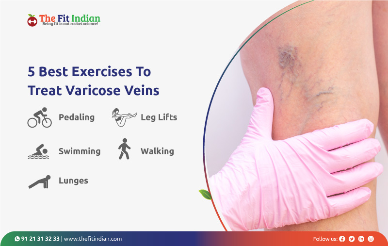 What are the exercises to treat varicose veins