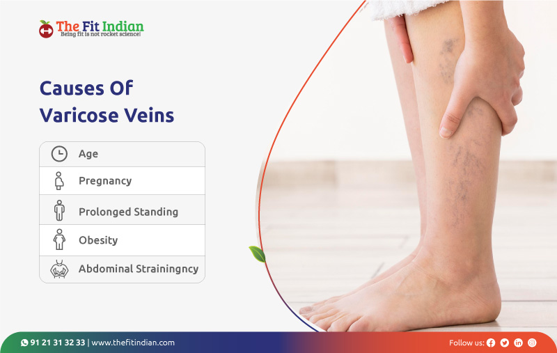 What are the causes of varicose veins